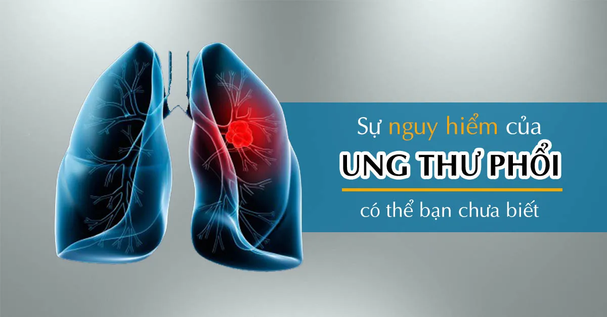 Ung thư phổi – nhận biết sớm để điều trị kịp thời, tránh di căn