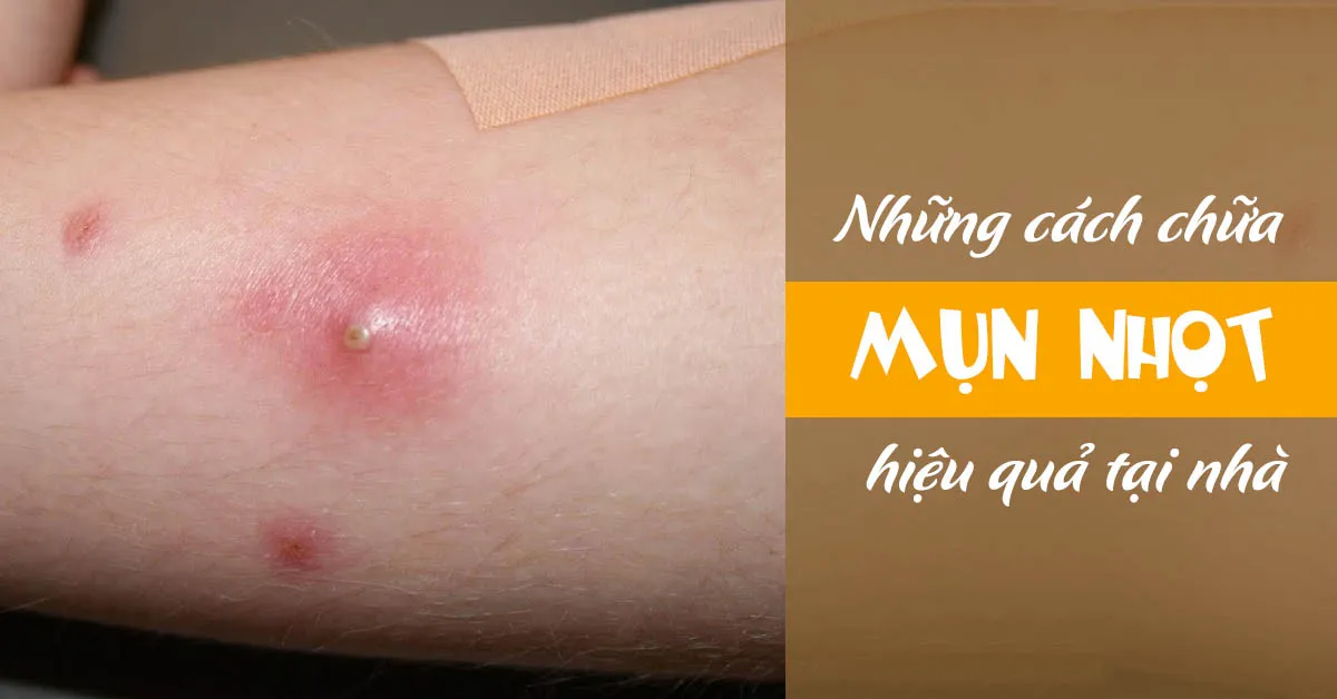 Mụn nhọt và cách điều trị hiệu quả