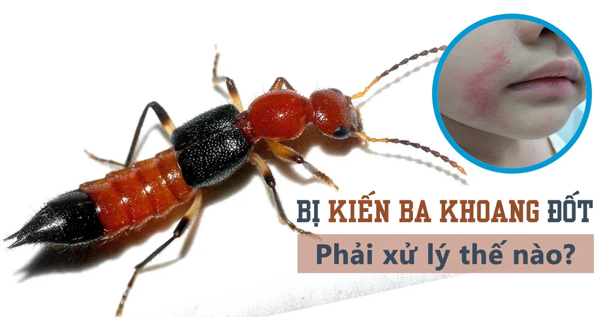 Bị kiến ba khoang đốt: Cách xử lý và phòng ngừa đơn giản