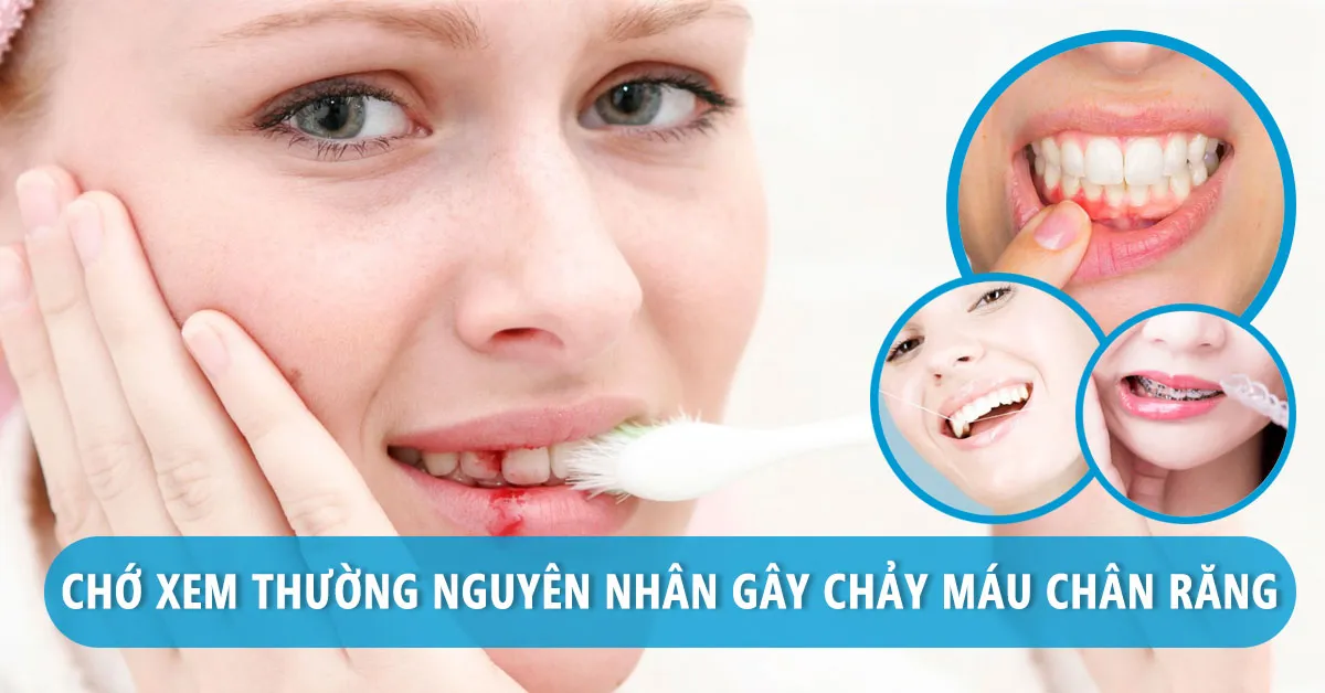 10 nguyên nhân gây chảy máu chân răng có thể bạn chưa biết