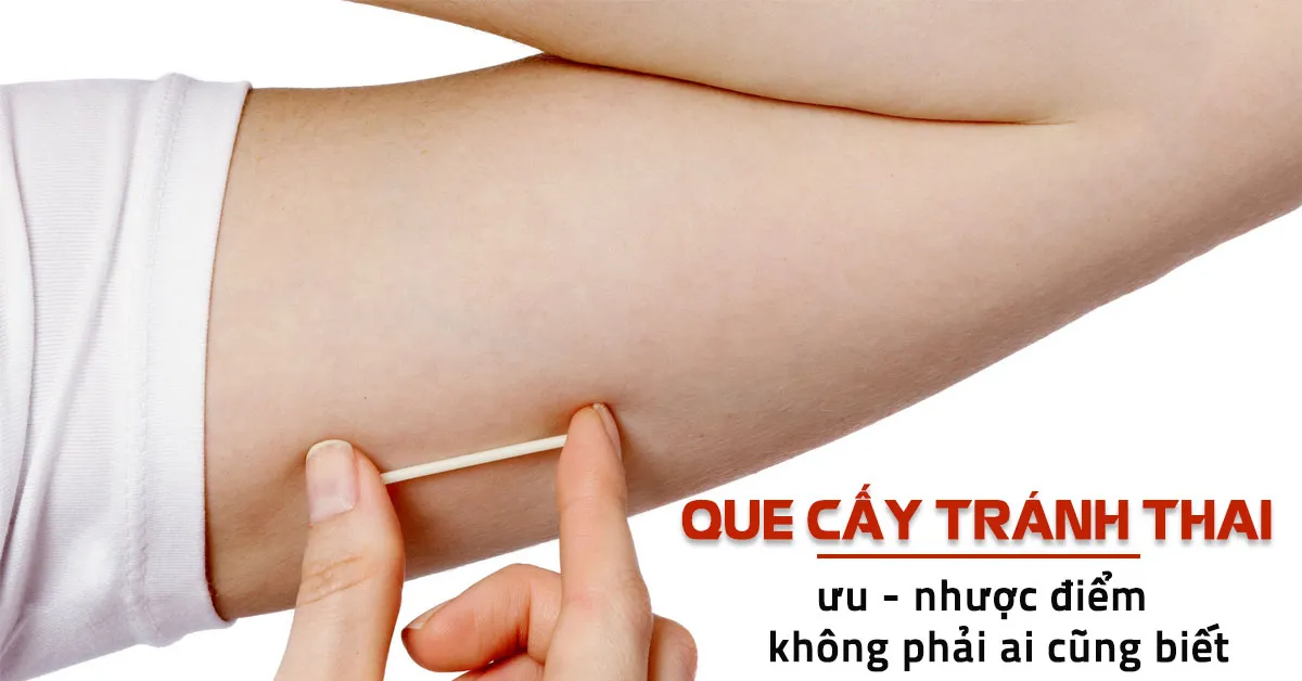 Que cấy tránh thai là gì, có an toàn hiệu quả khi dùng?