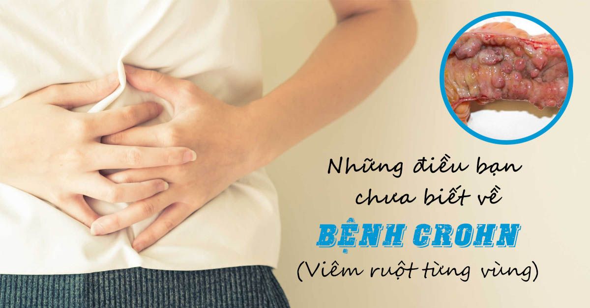 Bệnh Crohn là gì và có điều trị được không?