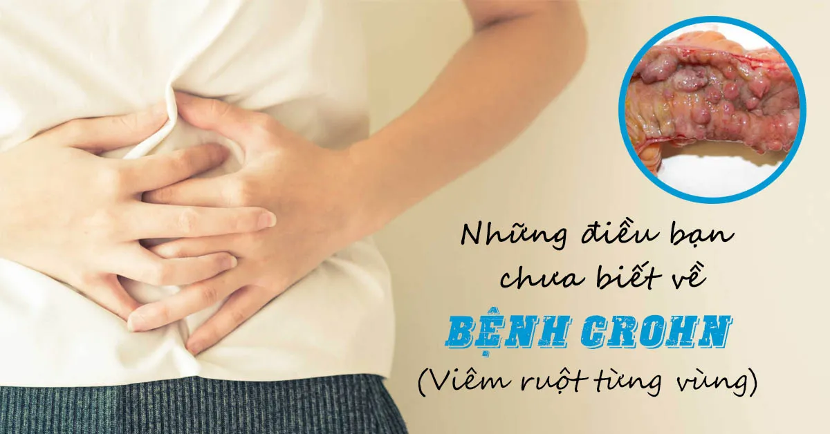 Bệnh Crohn là gì và có điều trị được không?