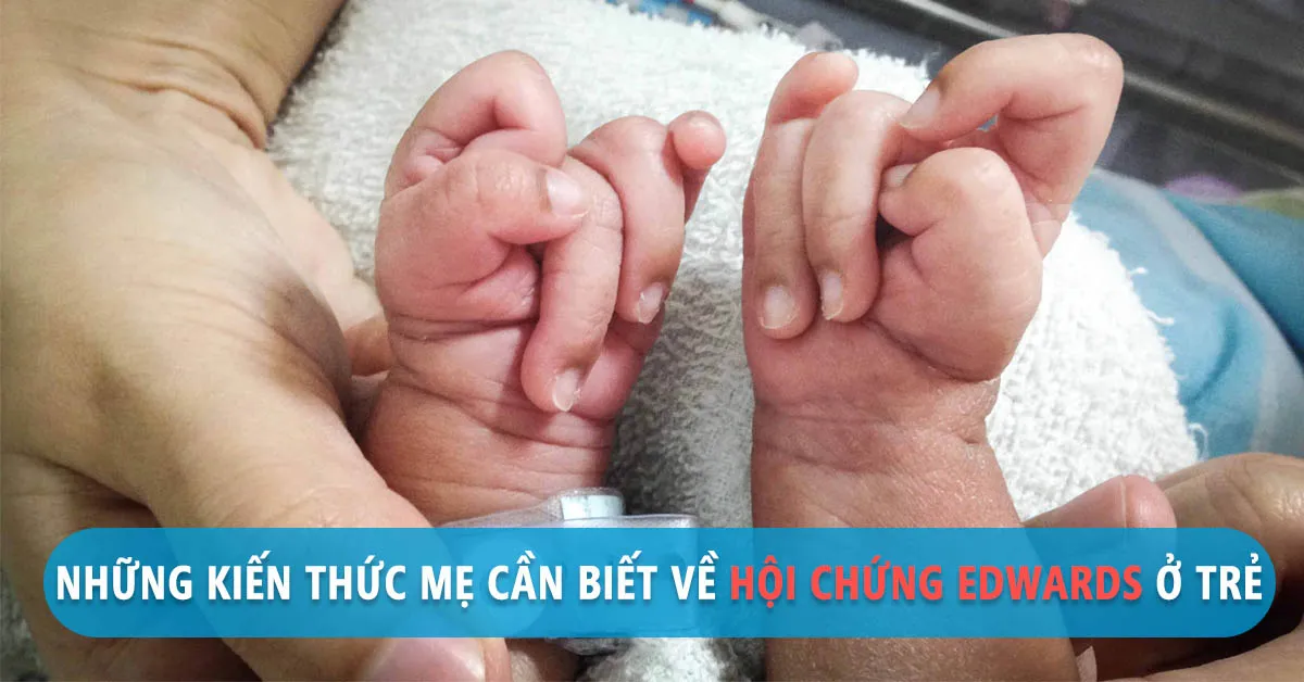 Hội chứng Edwards ở trẻ nhỏ là gì? Có trị được không?