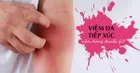 Viêm da tiếp xúc – dấu hiệu nhận biết sớm và cách điều trị nhanh nhất