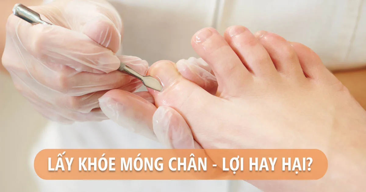 Lấy khóe chân – nên hay không nên?