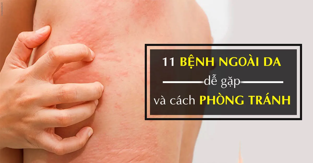 Bệnh ngoài da thường gặp và biện pháp phòng tránh