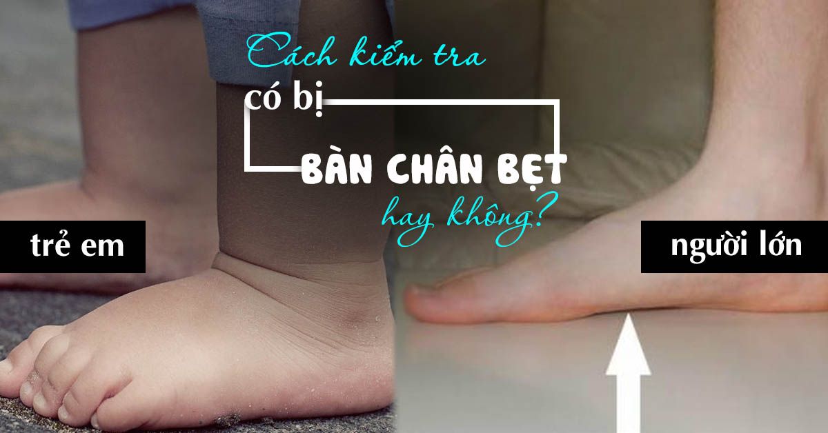 Bàn chân bẹt có nguy hiểm không?