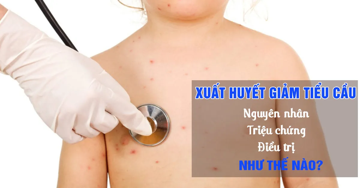 Xuất huyết giảm tiểu cầu ở trẻ em là bệnh gì?