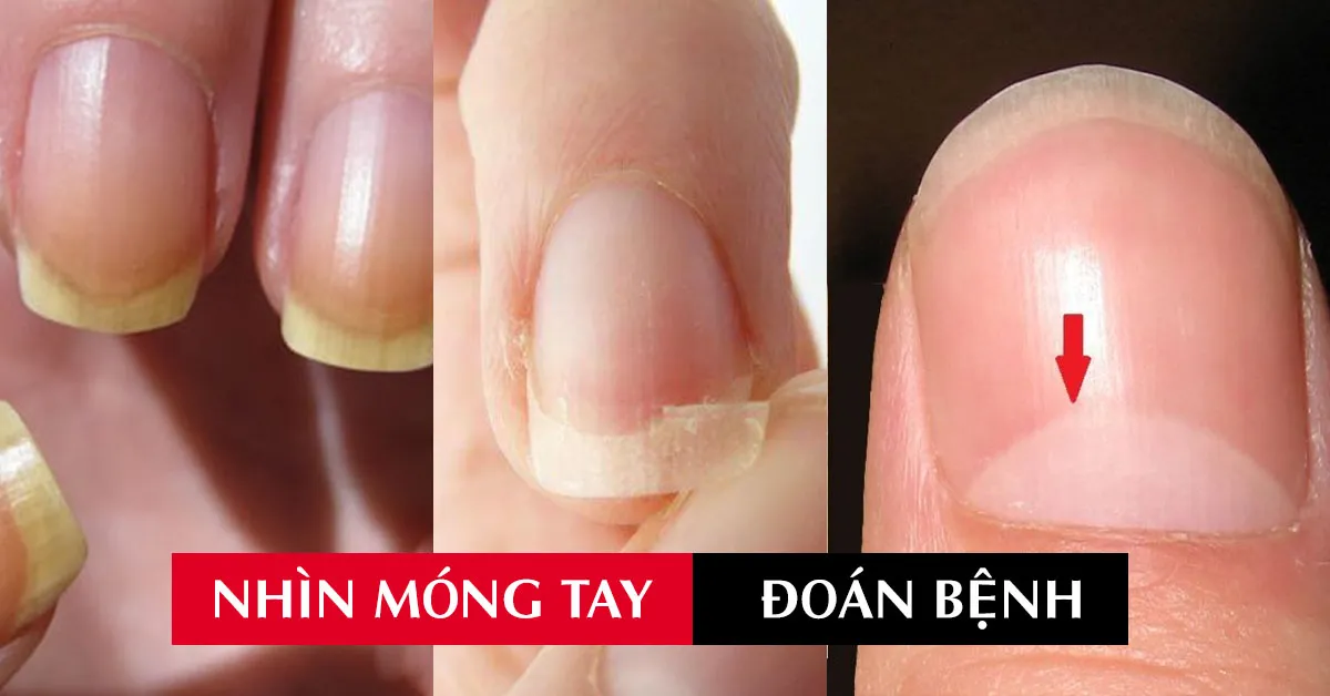 Móng tay biểu hiện sức khỏe ra sao?