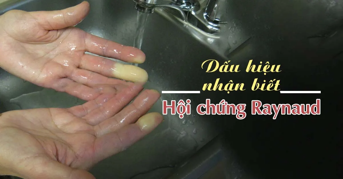 Hội chứng Raynaud là gì?