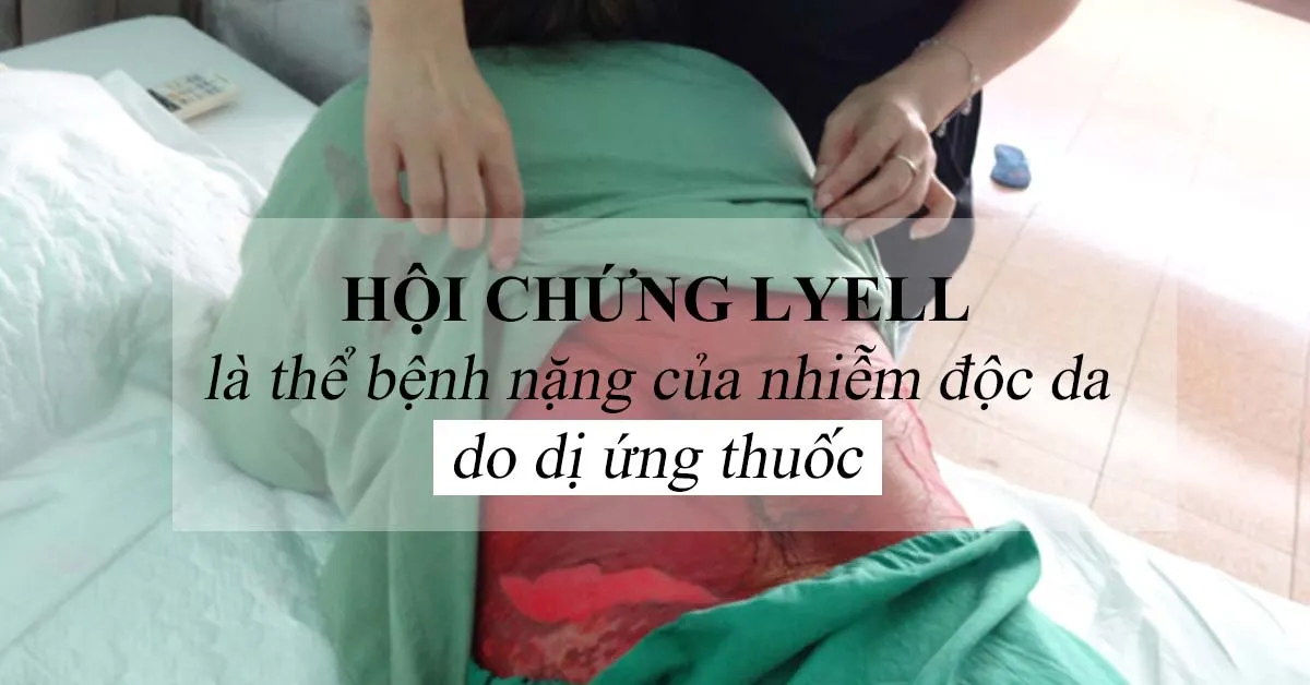 Hội chứng Lyell là gì? Nguyên nhân mắc bệnh và biện pháp điều trị hiệu quả