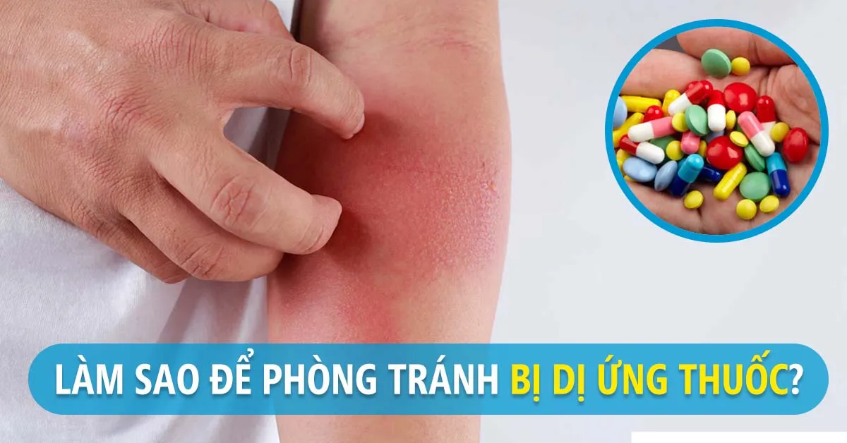 Dị ứng thuốc - dấu hiệu nhận biết, cách xử lý và phòng ngừa