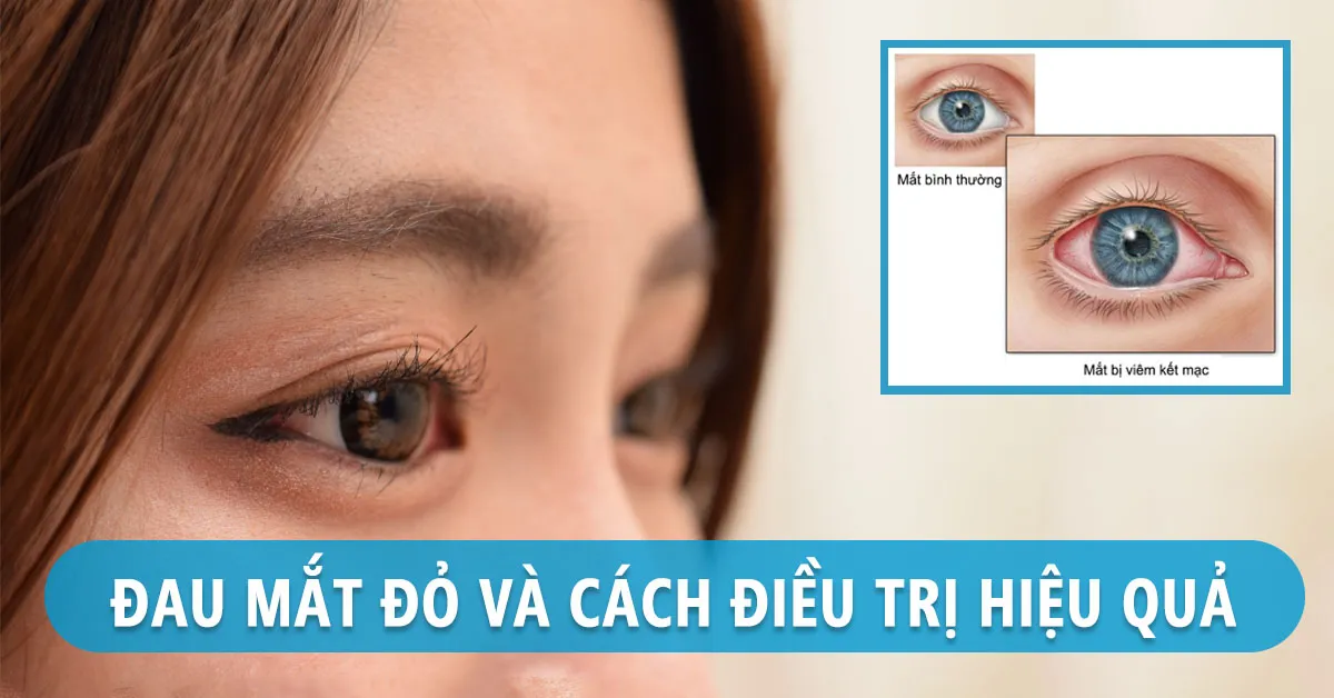 Đau mắt đỏ: Nguyên nhân, triệu chứng và cách điều trị
