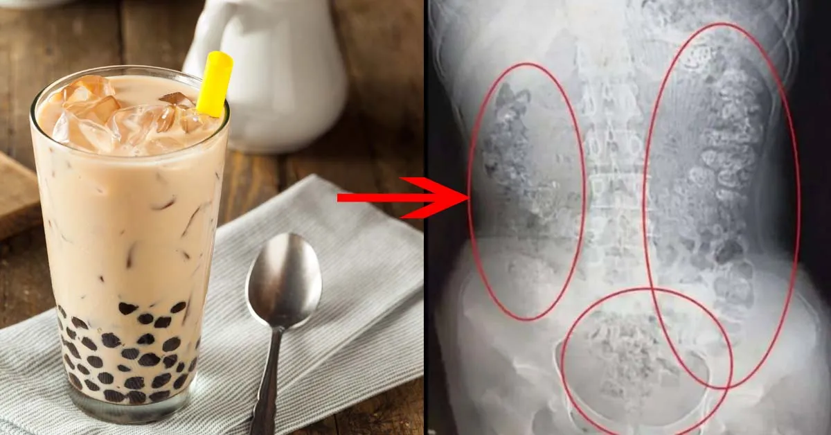 Bé gái nhập viện vì uống quá nhiều trà sữa trân châu