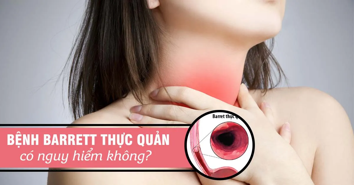 Barrett thực quản là gì, có nguy hiểm không?