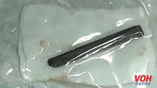 Đầu chiếc đũa 7 cm nằm trong hốc mắt 4 năm