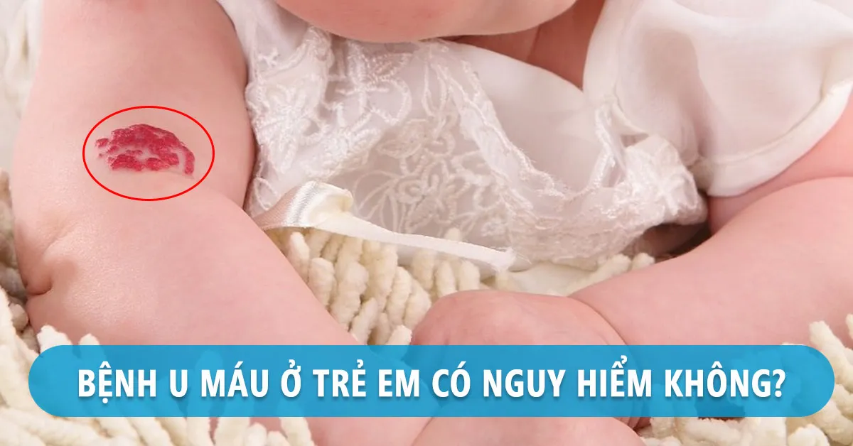 Dấu hiệu bệnh u máu ở trẻ sơ sinh và cách điều trị