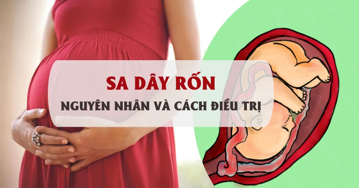 3 nguyên nhân chính gây sa dây rốn và cách điều trị