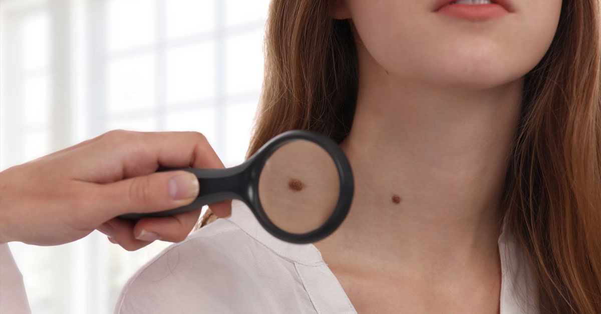 Nốt ruồi là gì? Nốt ruồi như thế nào được cho là nguy hiểm?
