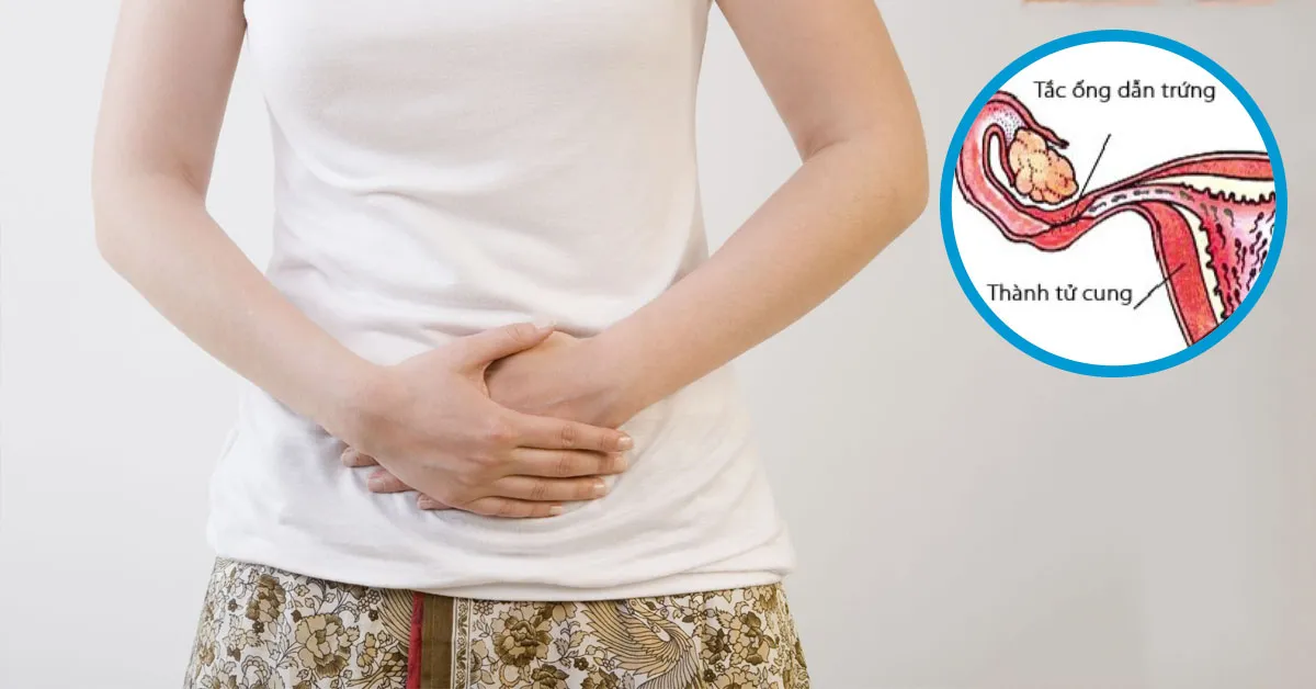 Tắc ống dẫn trứng là gì? Có cách nào điều trị?