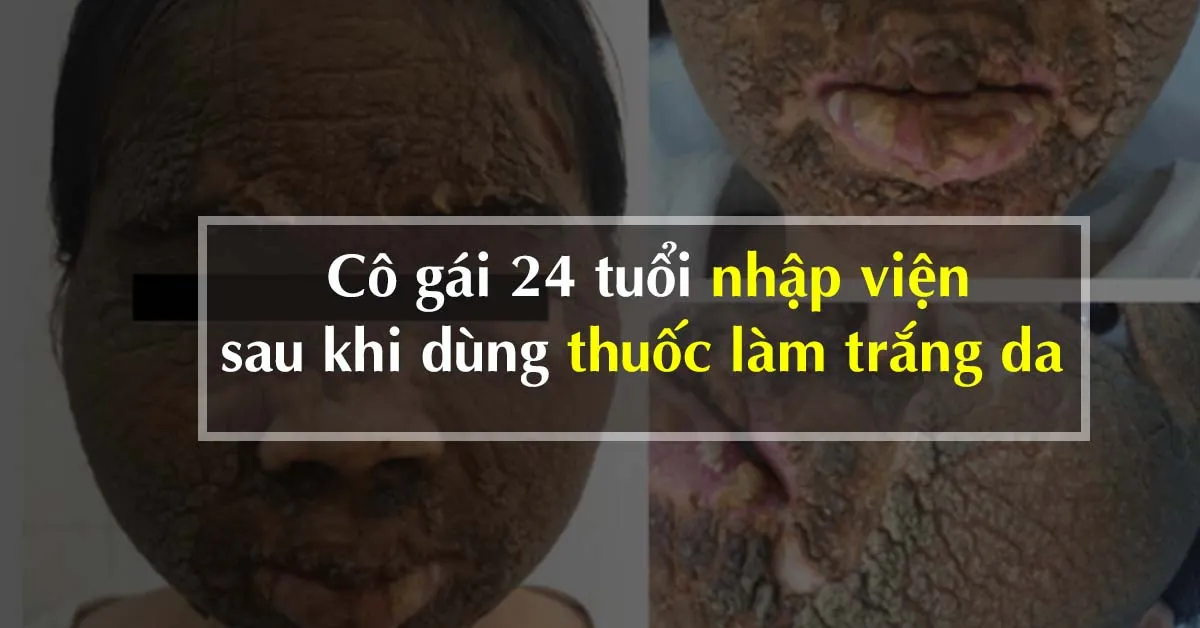 Thuốc làm trắng da khiến cô gái 24 tuổi nhập viện vì cả gương mặt đóng vảy