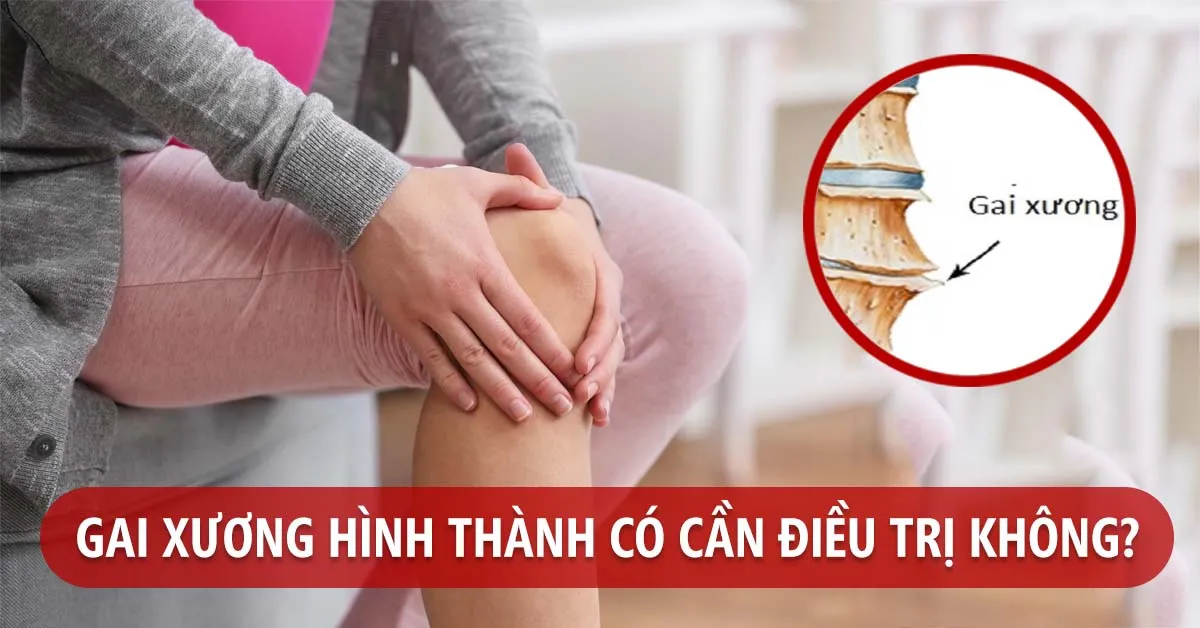 Gai xương là gì, có cần điều trị không?