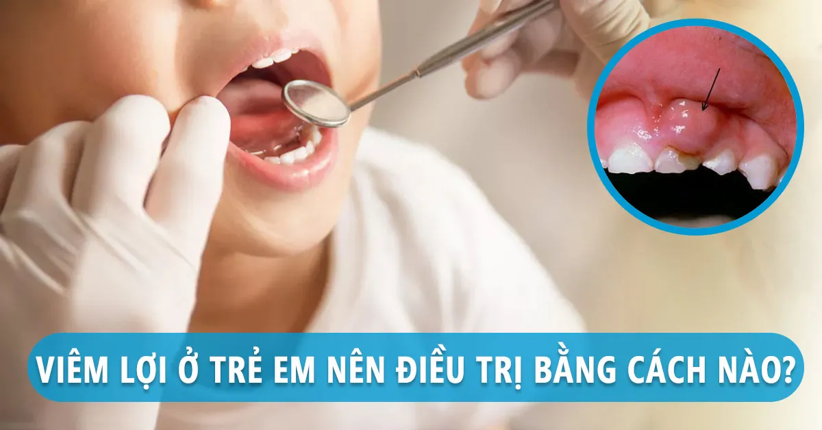 Cha mẹ cần làm gì khi nhận thấy các dấu hiệu trẻ bị viêm lợi?