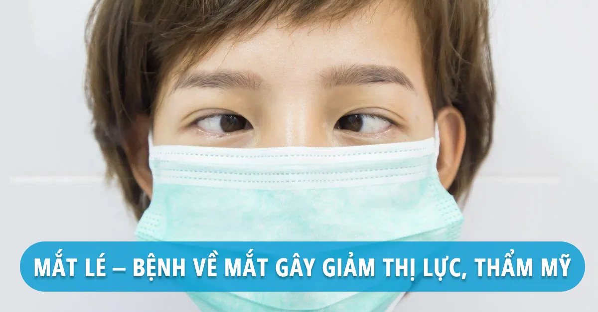 Mắt lé: Nguyên nhân, triệu chứng và cách điều trị