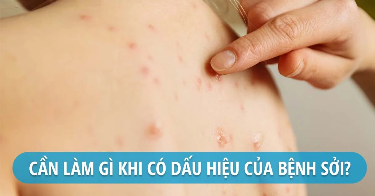 Bệnh sởi có ngứa không?