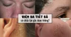 Viêm da tiết bã - những kiến thức quan trọng cần biết