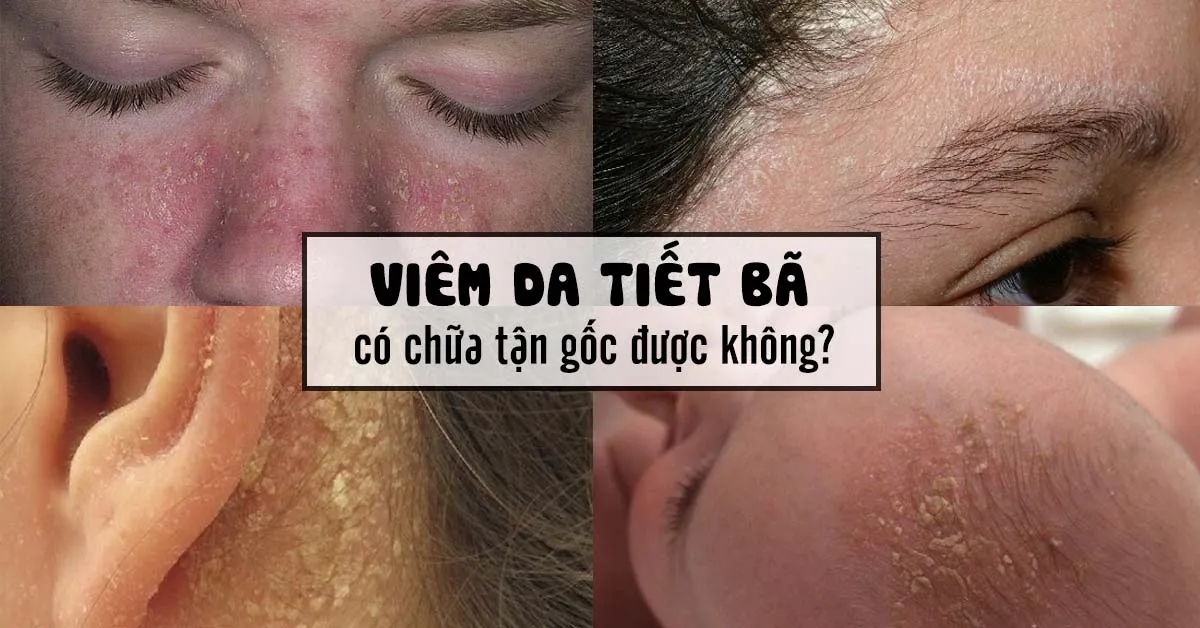 Viêm da tiết bã - những kiến thức quan trọng cần biết