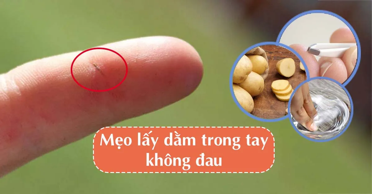 6 cách lấy dằm đâm vào tay, chân bằng những đồ vật trong nhà