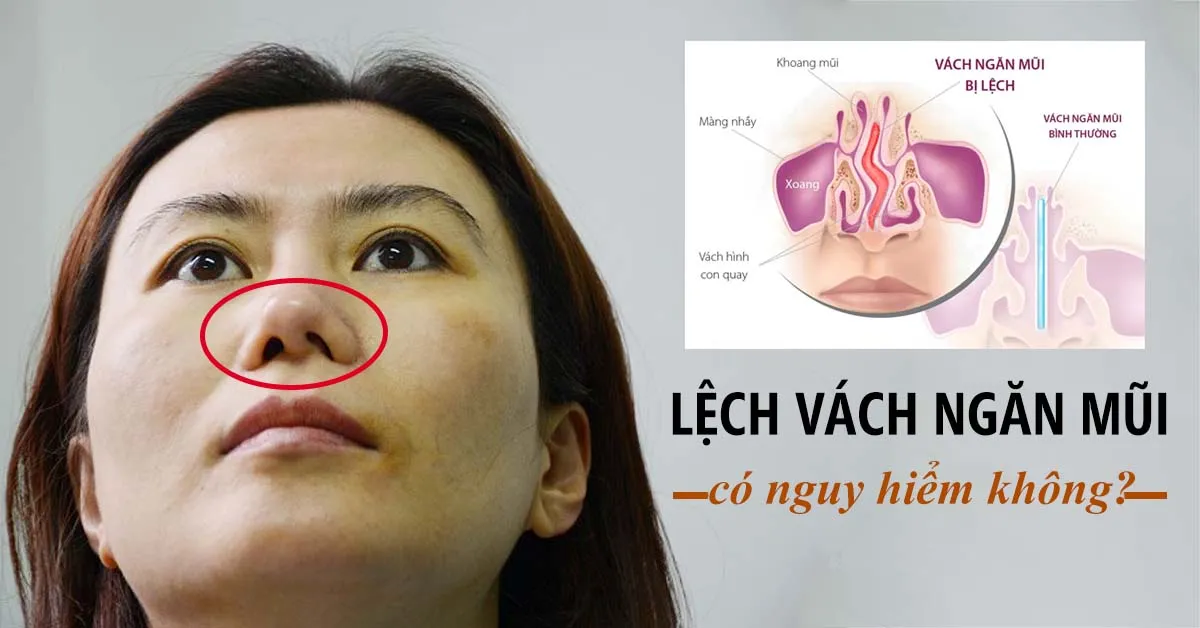 Lệch vách ngăn mũi có nguy hiểm không?