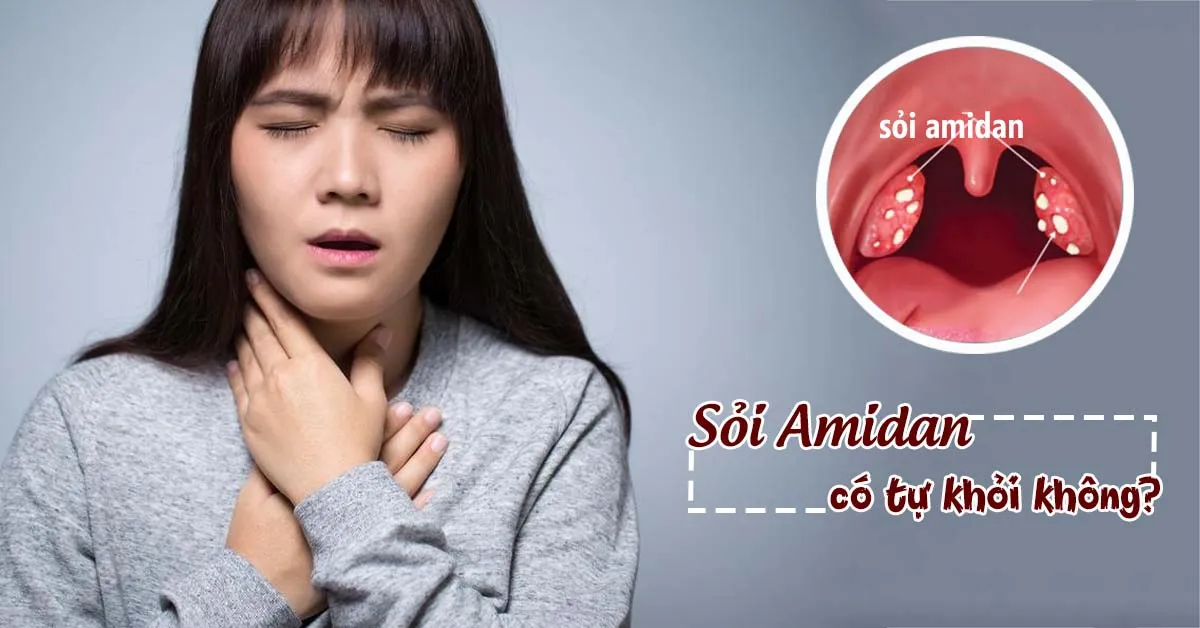 Sỏi amidan là gì, có cần chữa không?