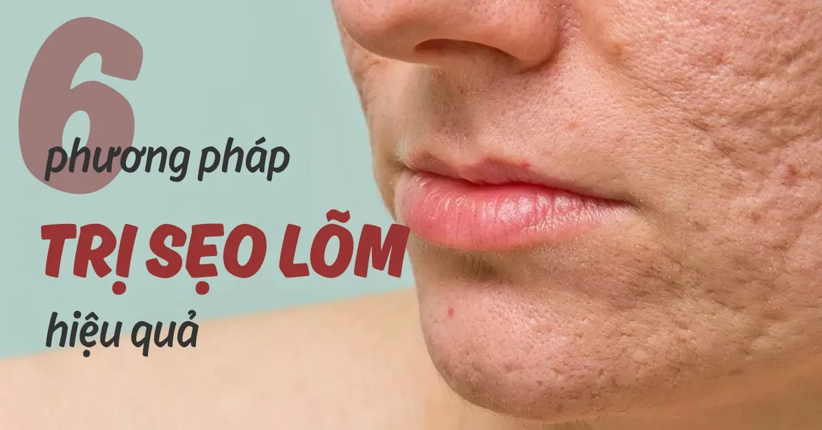 6 phương pháp trị sẹo lõm lâu năm đem lại hiệu quả cao