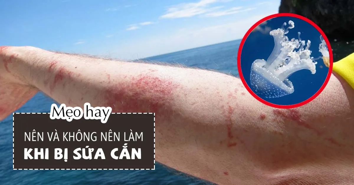 Bị sứa cắn nên làm gì?