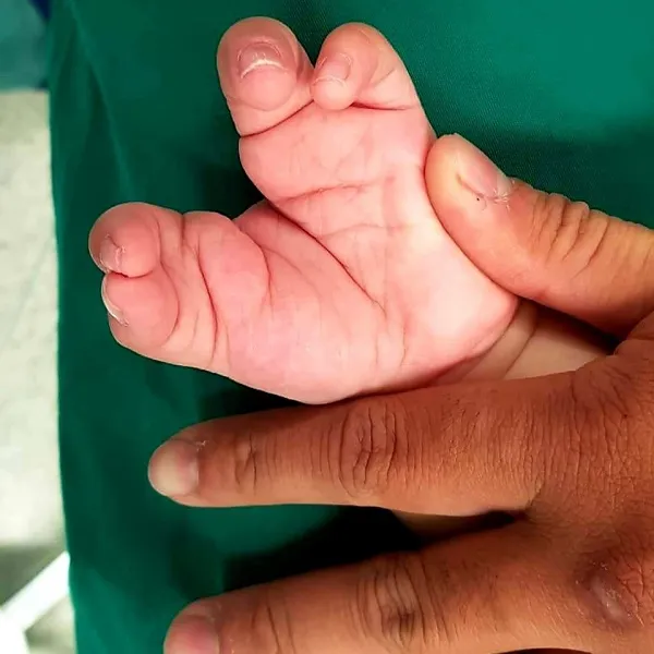 Tái phục hồi hình dạng tứ chi cho bé bị dị tật càng cua hiếm gặp