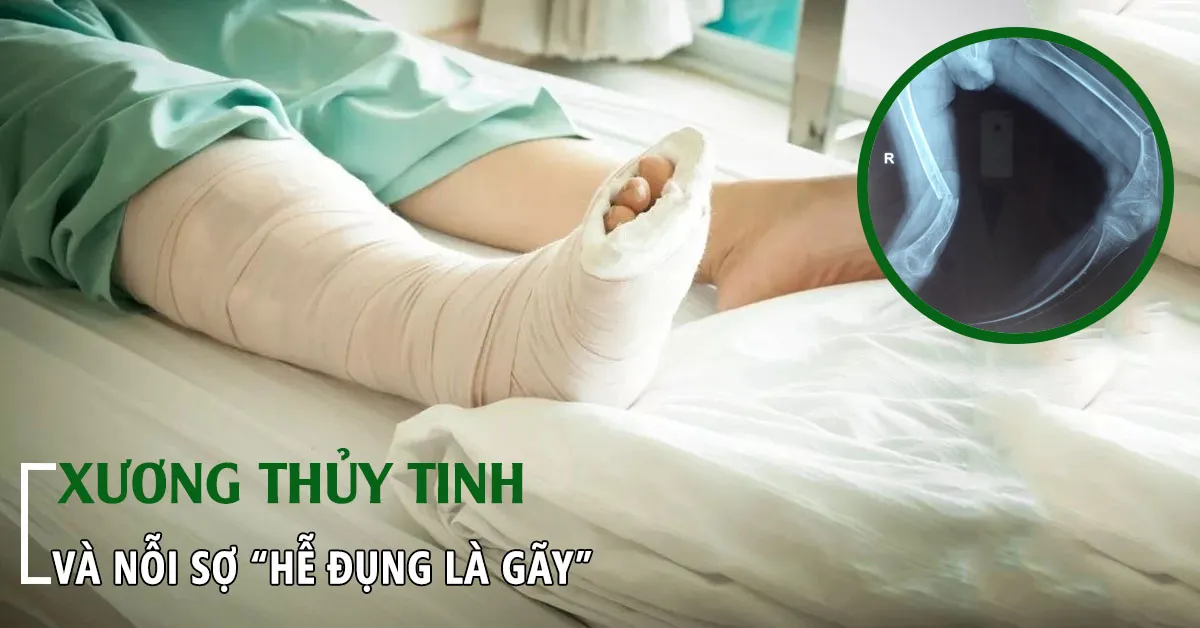 Xương thủy tinh là bệnh gì và có thể điều trị được không?