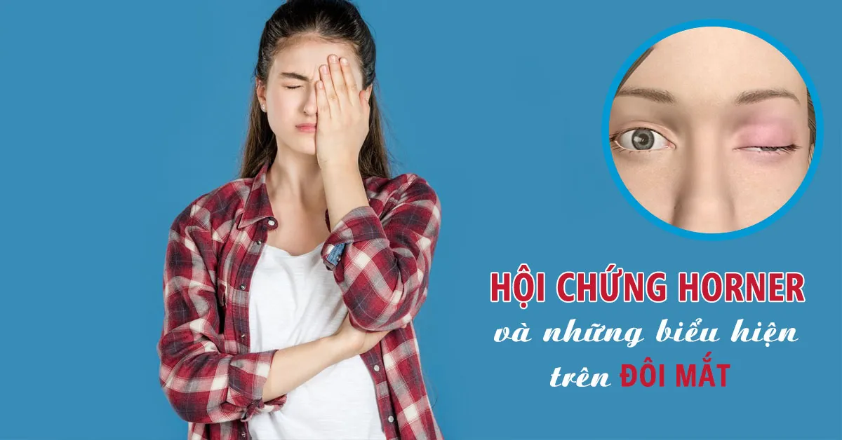 Hội chứng Horner: Triệu chứng, nguyên nhân và cách điều trị