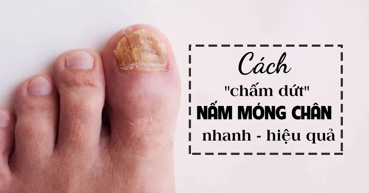 Cách trị nấm móng chân hiệu quả bằng thuốc và giấm