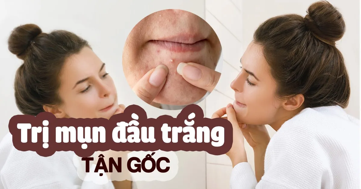 3 cách trị mụn đầu trắng tận gốc giúp bạn tạm biệt làn da sần sùi