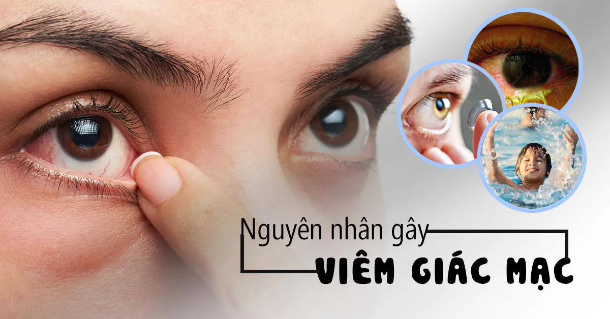 Viêm giác mạc: Nguyên nhân, hướng điều trị và cách phòng tránh