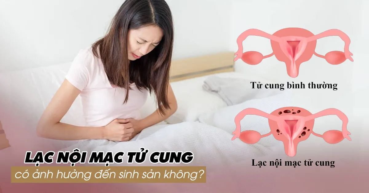 Lạc nội mạc tử cung có gây vô sinh không?