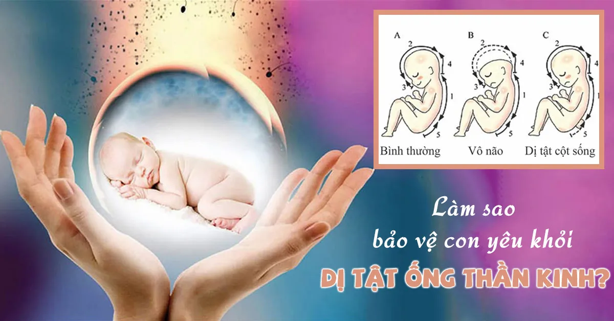 3 nguyên nhân gây dị tật ống thần kinh thai nhi và cách phòng ngừa