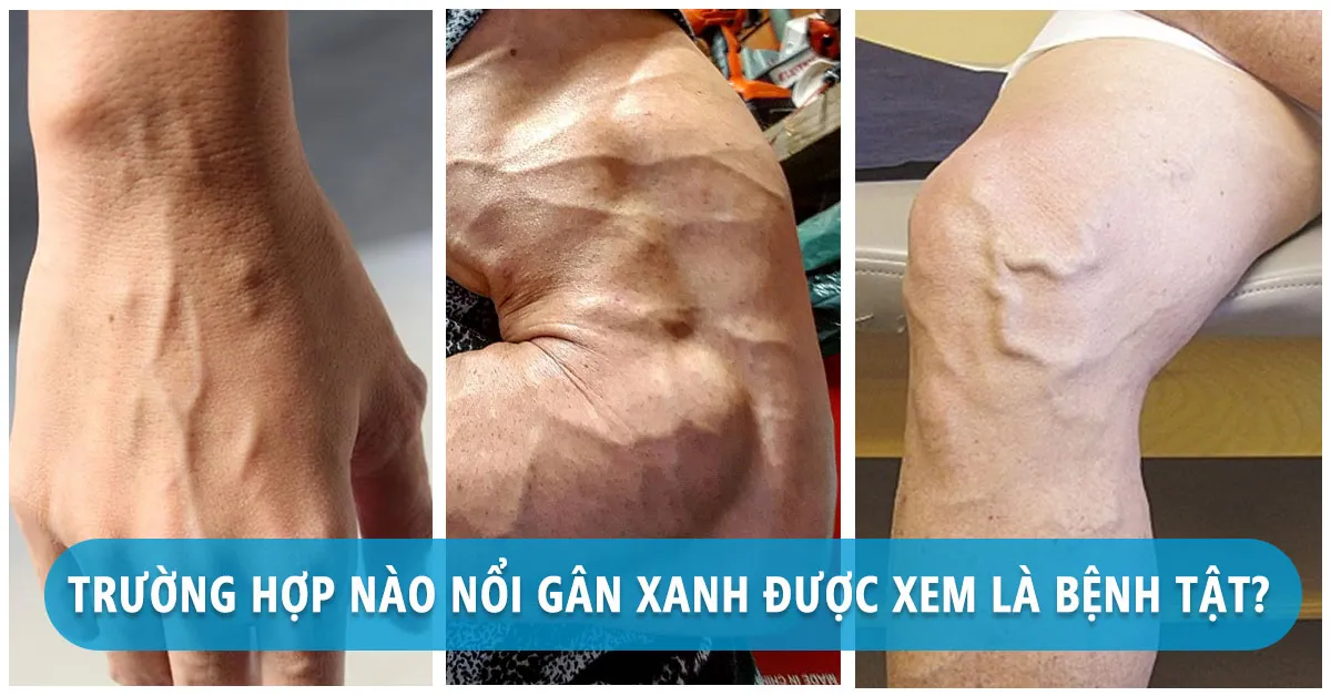 Nổi gân xanh dưới da báo hiệu điều gì về sức khỏe?