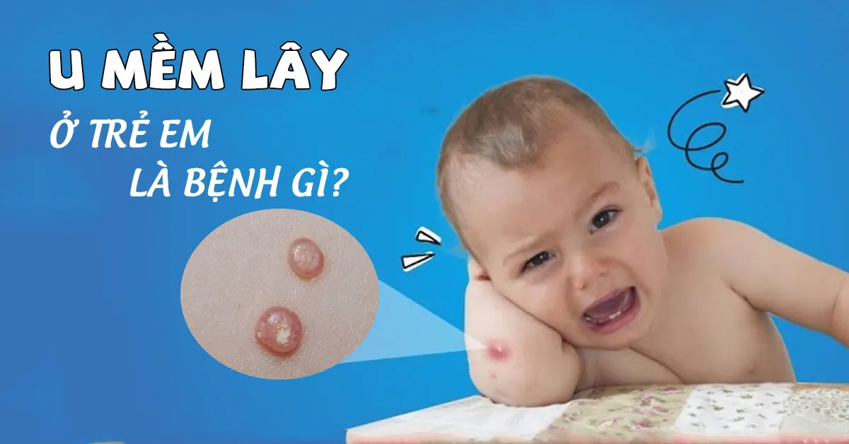 U mềm lây ở trẻ em là gì? Điều trị như thế nào?