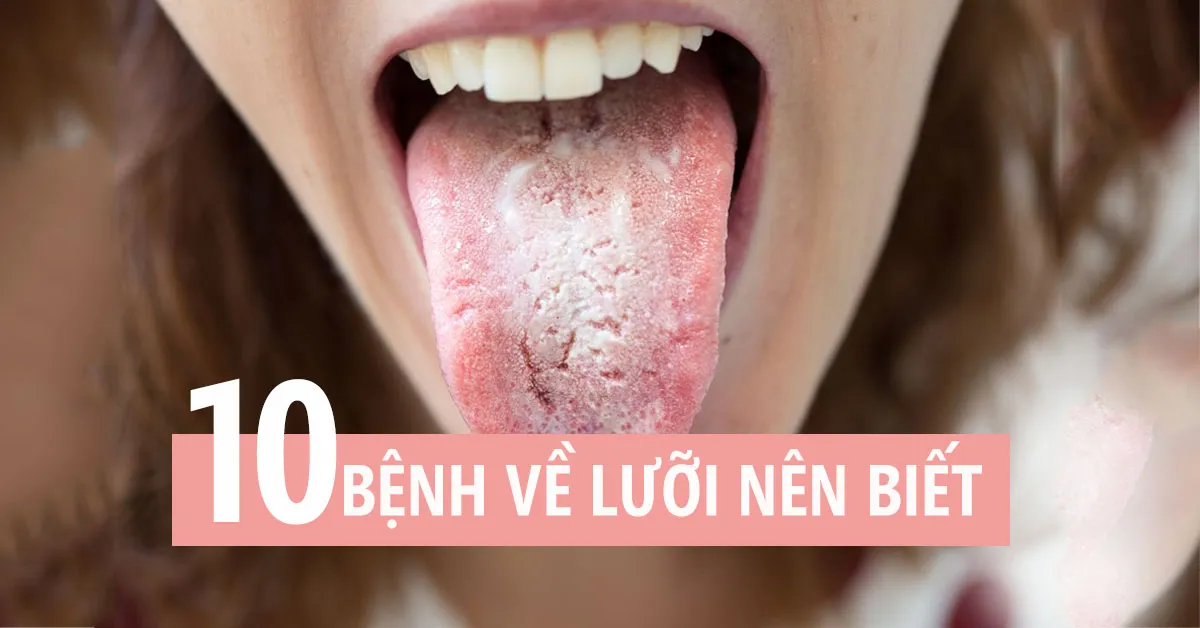 10 bệnh về lưỡi thường gặp, ai cũng nên biết