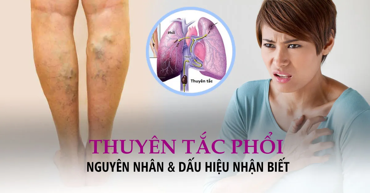 Thuyên tắc phổi: Nguyên nhân và dấu hiệu nhận biết sớm