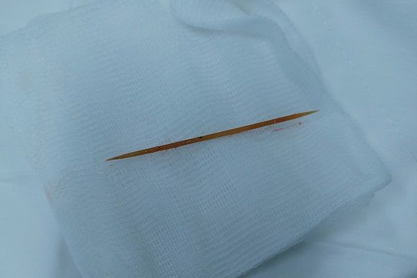 Tăm tre đâm xuyên nội tạng gây tràn dịch màng ngoài tim